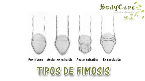 fimosis foto|Imágenes